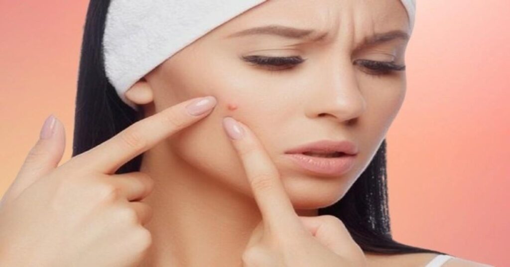 Remove Blackheads and Whiteheads