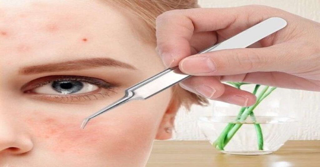 Remove Blackheads and Whiteheads