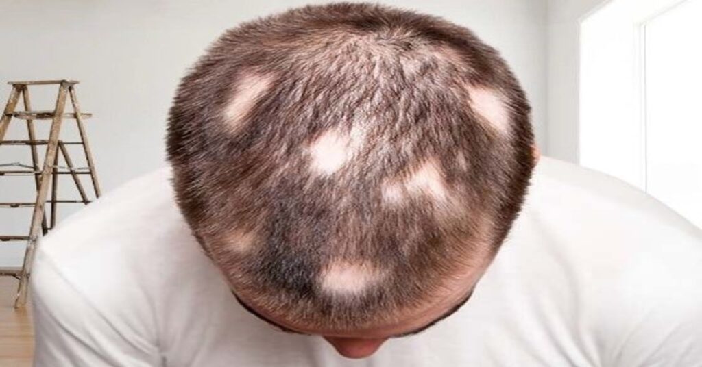 Hair fall control 